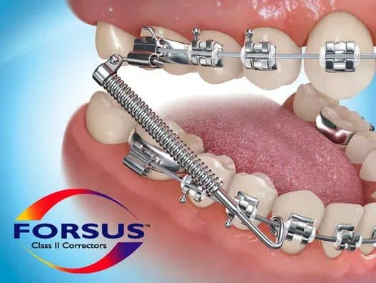 Khí cụ điều chỉnh khớp cắn FORSUS - Hạng II | Solventum Mỹ