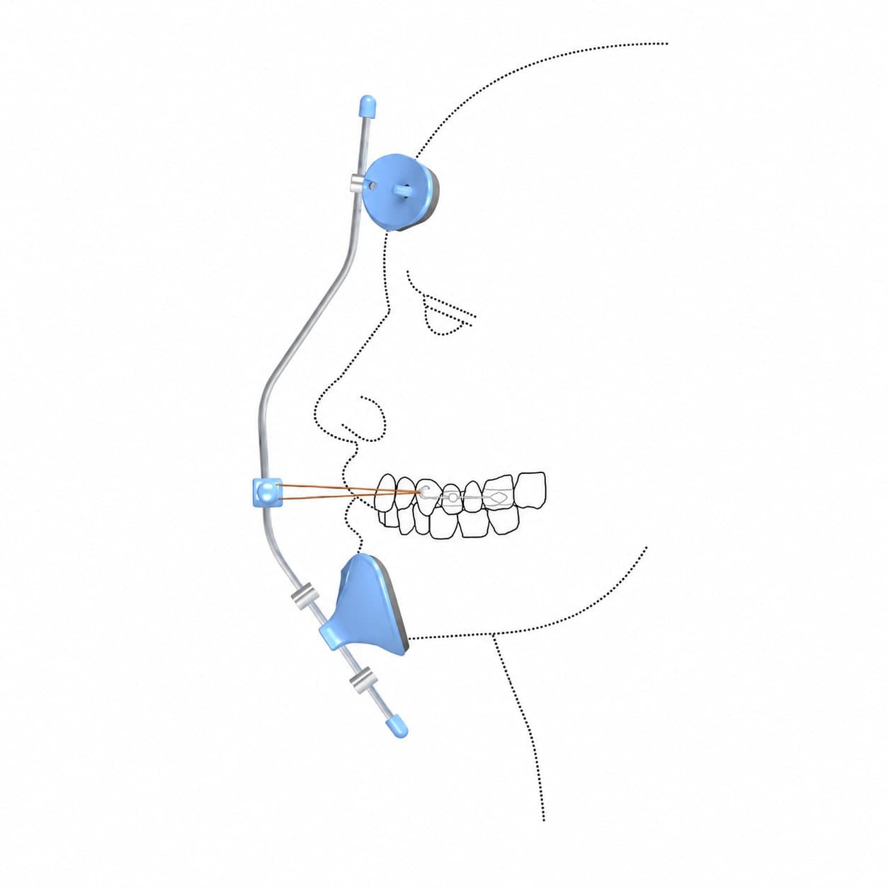 Facemask chỉnh nha - Morelli