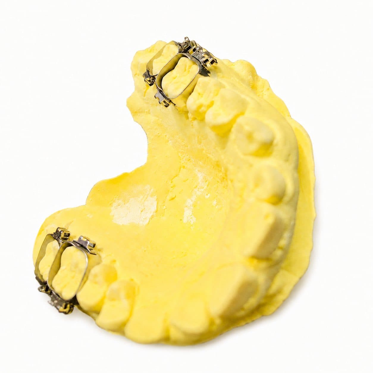 Khâu chỉnh nha 1 ống/ 2 ống răng 6, răng 7 - American Orthodontics - 31 / 43+ / Khâu 2 ống / 46