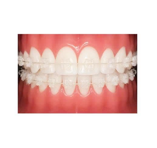 Mắc cài sứ chỉnh nha 3M Unitek Gemini Clear Ceramic Brackets 117-100