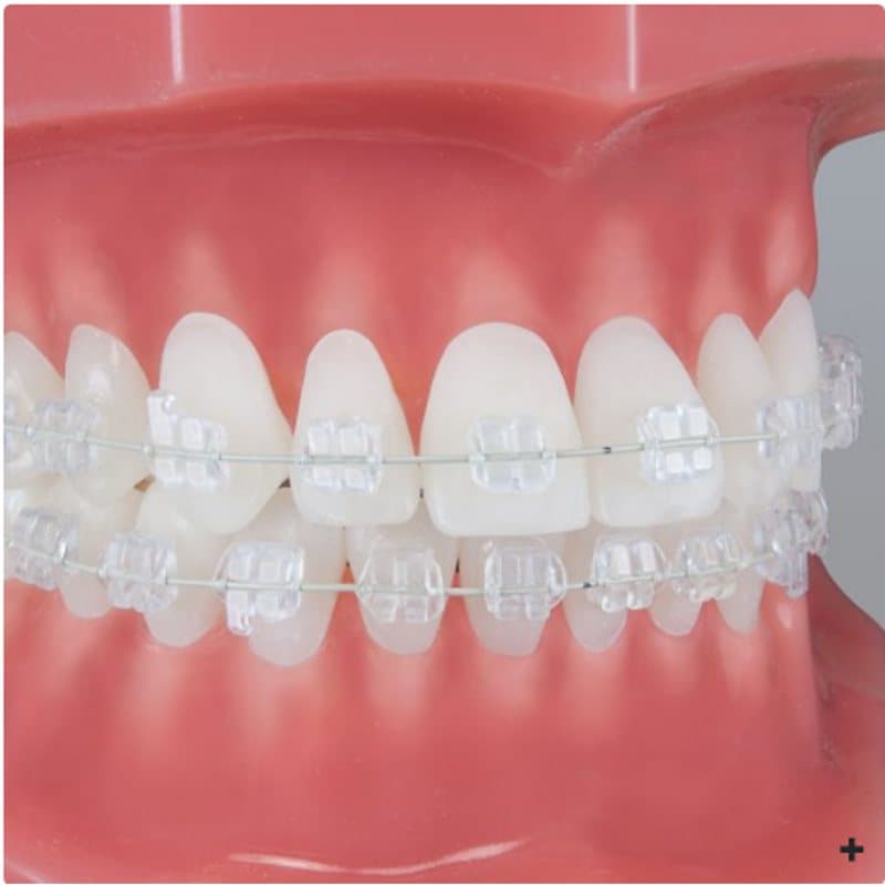 Mắc cài sứ Sapphire PURE - Ortho Technology