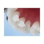 Miếng nâng khớp răng trước - Ortho Technology