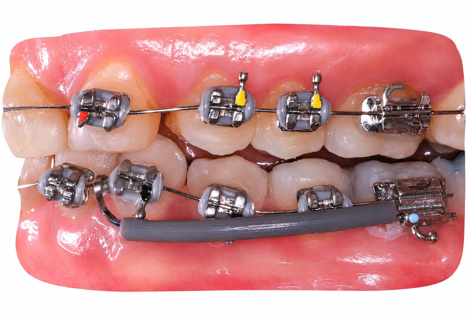 Ống luồn dây cung - Dynaflex