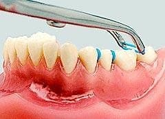 Thun tách kẽ xanh - Ortho Technology