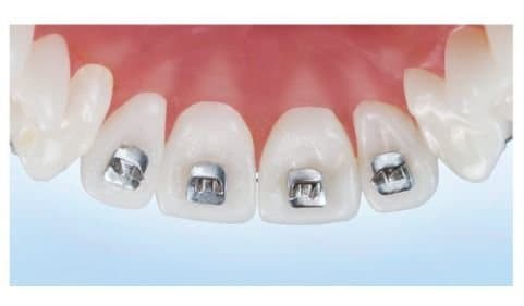 Nút kim loại chặn đẩy lưỡi chỉnh nha - Ortho Techology