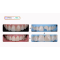 phuc-hoi-rang-cua-me-cu-bang-ky-thuat-phan-lop-3-mau-composite